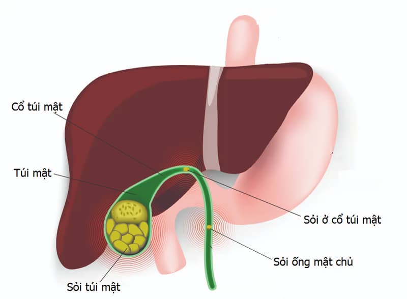 Sỏi túi mật: Nguyên nhân, triệu chứng, biến chứng và cách điều trị