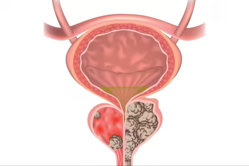 Sỏi tuyến tiền liệt: Nguyên nhân, dấu hiệu và cách điều trị