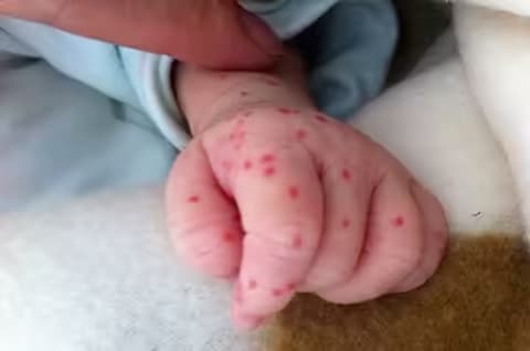 Sốt xuất huyết ở trẻ em: Dấu hiệu, biến chứng và nguyên tắc chăm sóc