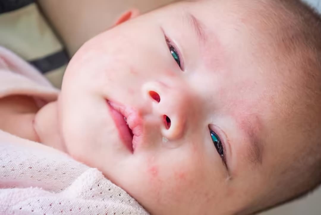 Sốt xuất huyết ở trẻ sơ sinh: Dấu hiệu và cách chăm sóc