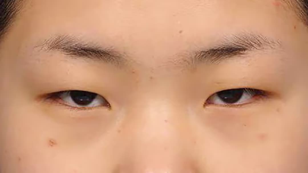Sụp mi mắt: Nguyên nhân, dấu hiệu, biến chứng và cách điều trị