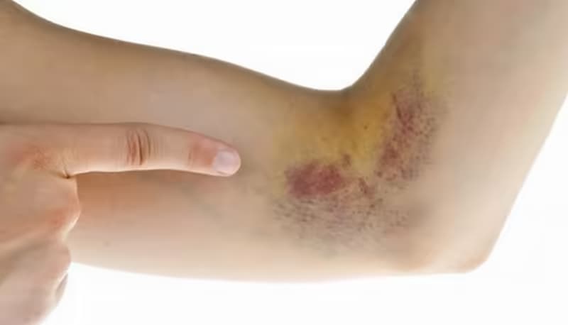 Suy tủy xương: Nguyên nhân, dấu hiệu và cách điều trị