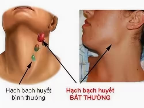 Sưng hạch bạch huyết: Nguyên nhân, dấu hiệu và cách xử trí