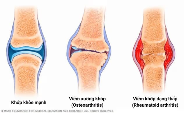 Sưng khớp: Dấu hiệu, nguyên nhân, chẩn đoán và cách điều trị