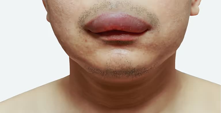 Sưng môi: Dấu hiệu, nguyên nhân và các biện pháp xử trí