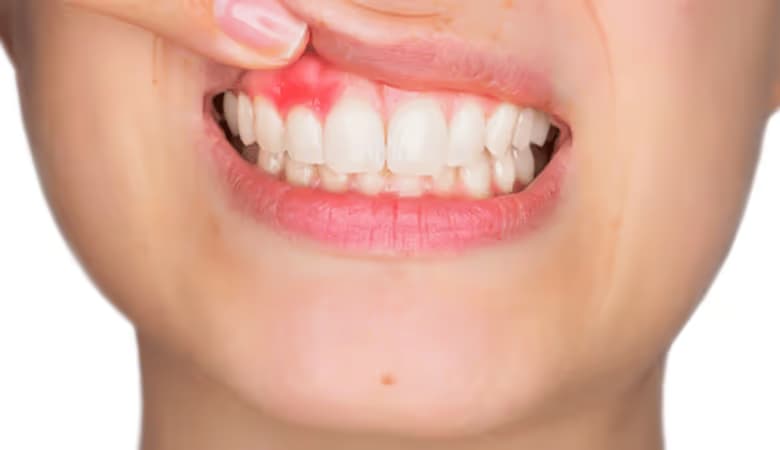 Sưng nướu răng: Nguyên nhân, dấu hiệu và cách xử trí
