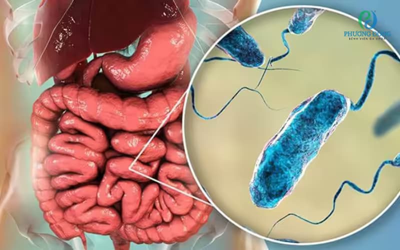 Bệnh tả: Dấu hiệu, nguyên nhân, cách xử trí và phòng ngừa lây nhiễm