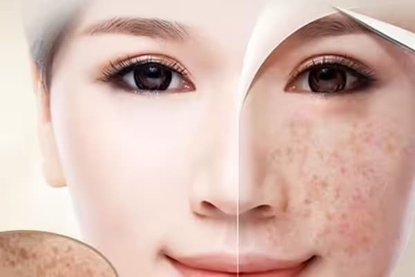 Tàn nhang: Nguyên nhân, dấu hiệu và cách chăm sóc