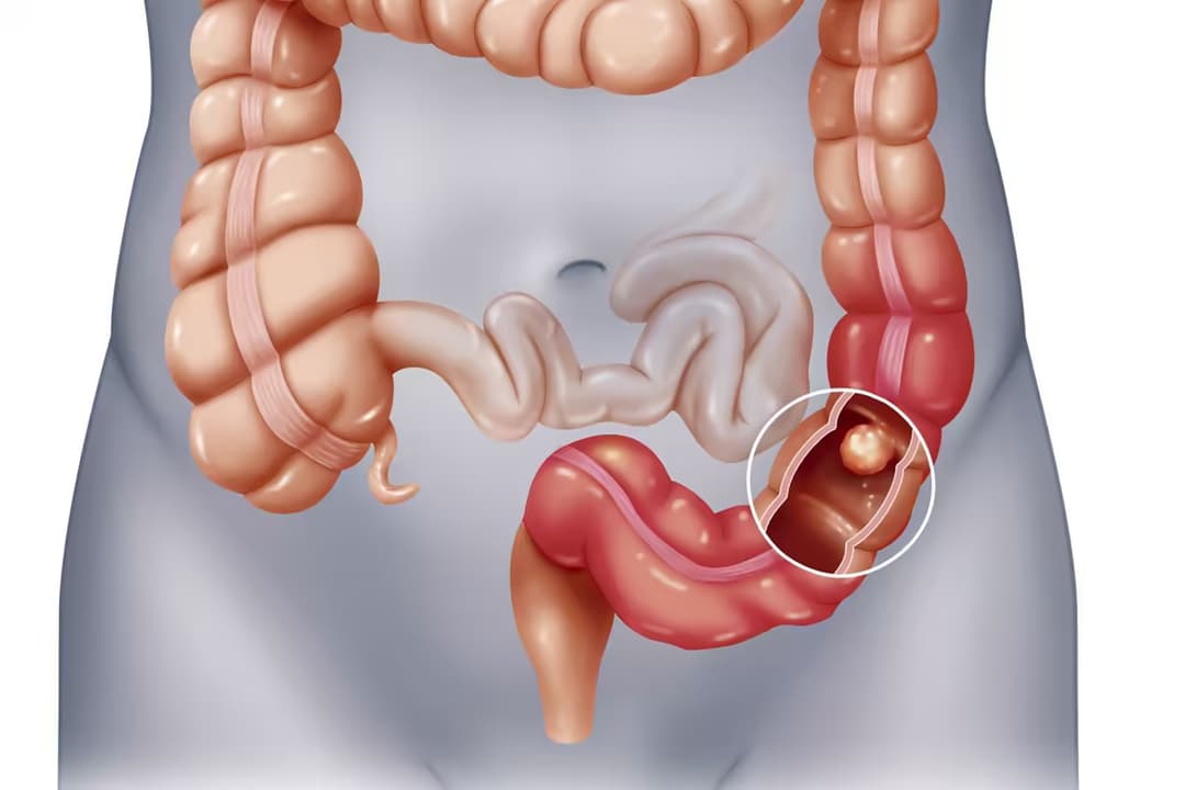 Tắc ruột: Nguyên nhân, dấu hiệu và cách xử trí