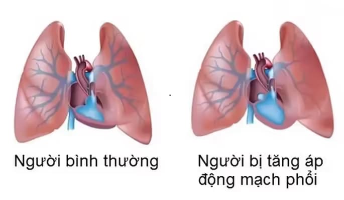 Tăng áp phổi: Nguyên nhân, dấu hiệu và cách điều trị