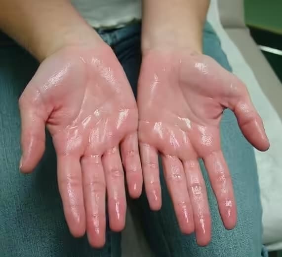 Tăng tiết mồ hôi: Nguyên nhân, dấu hiệu và cách điều trị