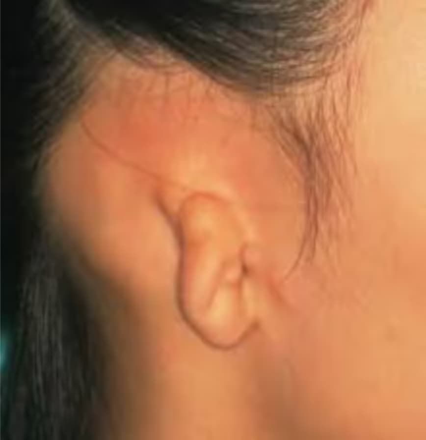 Tật tai nhỏ ở trẻ: Nguyên nhân, dấu hiệu và các phương pháp can thiệp