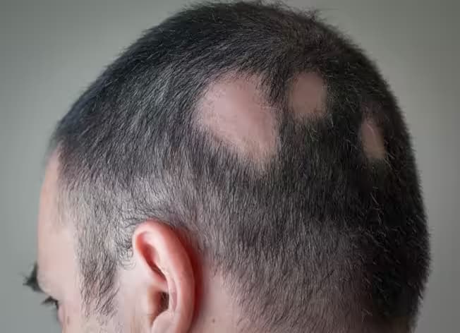 Rụng tóc: Nguyên nhân thường gặp và cách khắc phục
