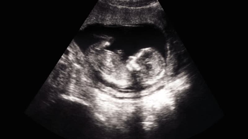 Thai nhi có chiều dài xương đùi ngắn có ảnh hưởng sức khỏe không