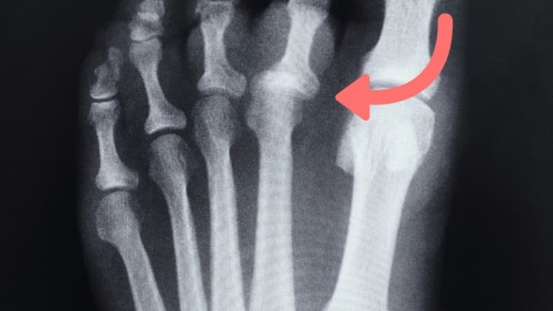 Trật khớp ngón chân: Nguyên nhân thường gặp và cách xử trí đúng cách