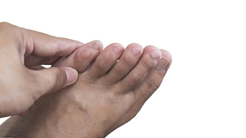 U bướu ở ngón chân có nguy hiểm không và các nguyên nhân thường gặp