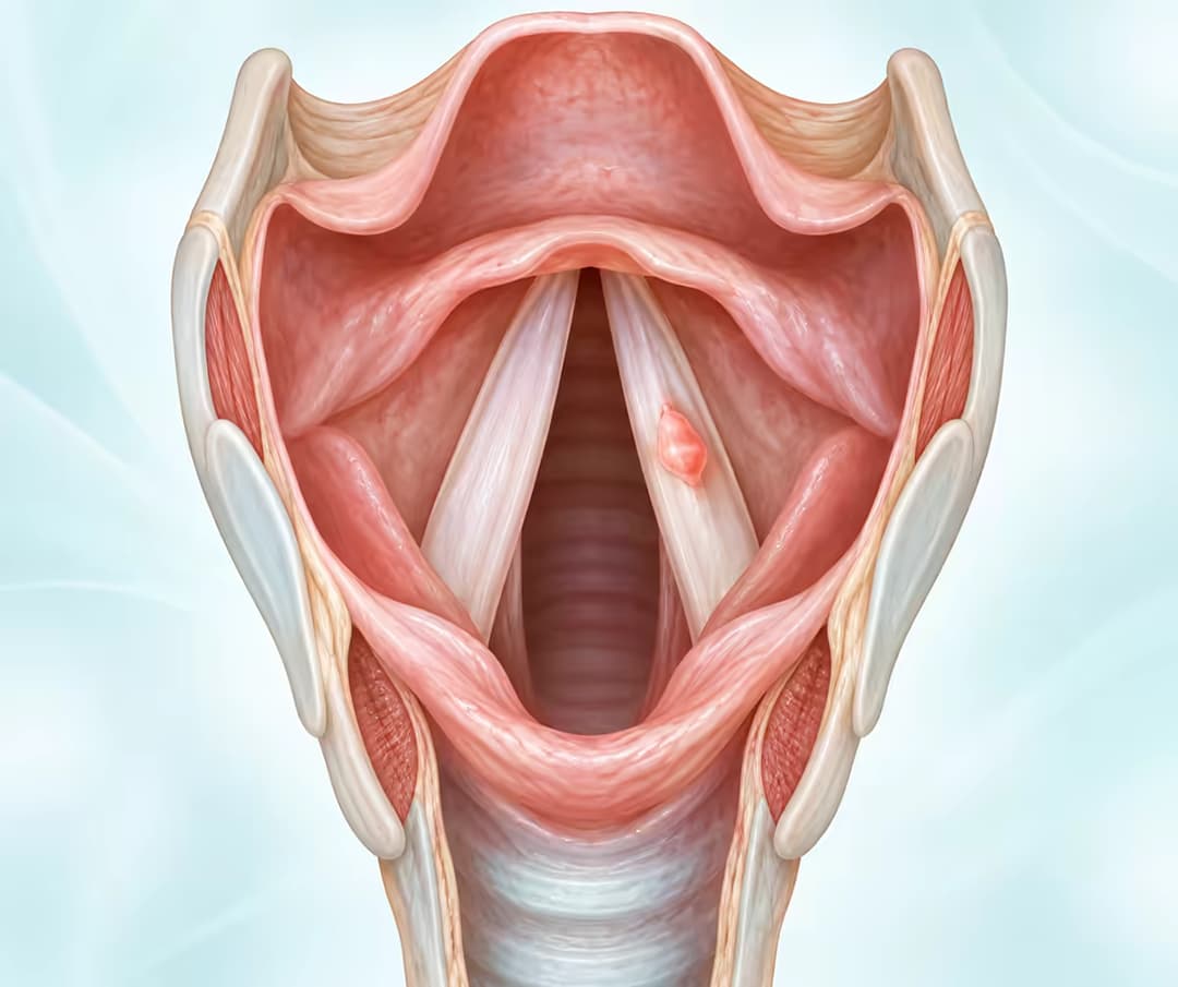 U sùi dây thanh quản có nguy hiểm không và những thông tin cần biết