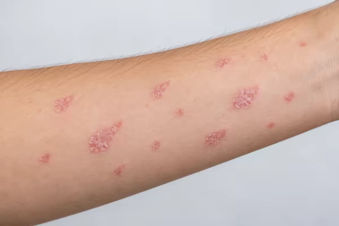 Vảy nến thể hạt cơm là gì và những thông tin cần biết