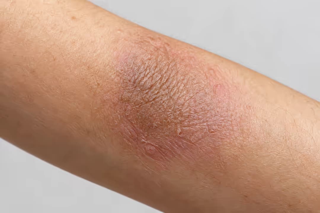 Viêm da thần kinh là bệnh lý như thế nào và cách kiểm soát cơn ngứa