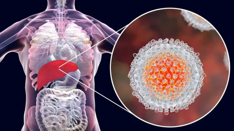 Viêm gan B cấp mã B16 là bệnh gì và những lưu ý chăm sóc sức khỏe gan