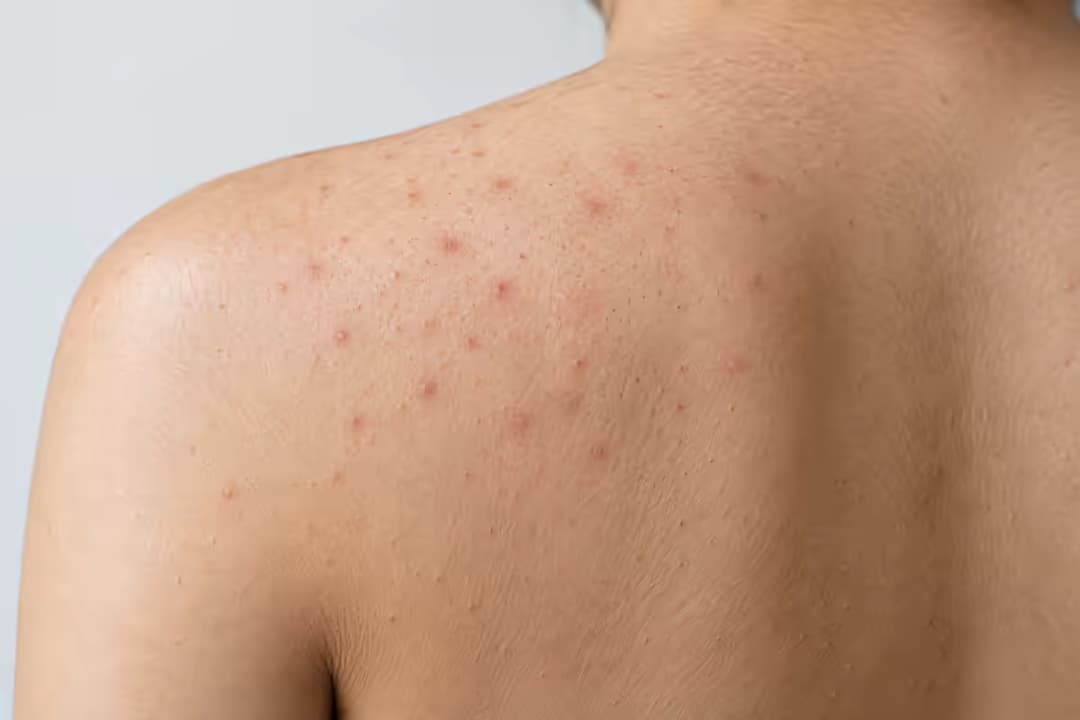 Viêm nang lông Malassezia: Nguyên nhân, biểu hiện và cách chăm sóc da