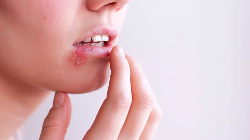 Nhiễm virus Herpes simplex: Chủng virus, đường lây truyền và cách phòng ngừa