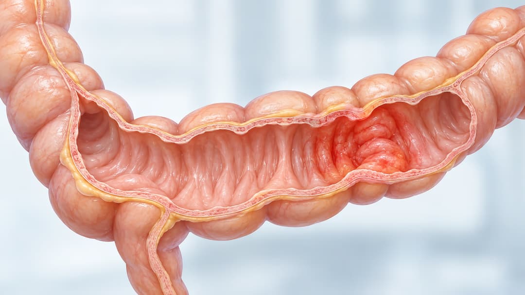 Viêm ruột hoại tử ở người lớn: Nguyên nhân, biểu hiện và cách xử trí