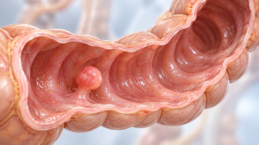 Mối liên quan giữa polyp và nguy cơ ung thư đại trực tràng