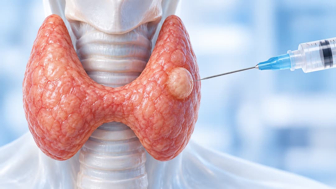 Quy trình thực hiện xét nghiệm FNA tuyến giáp và những điều cần biết