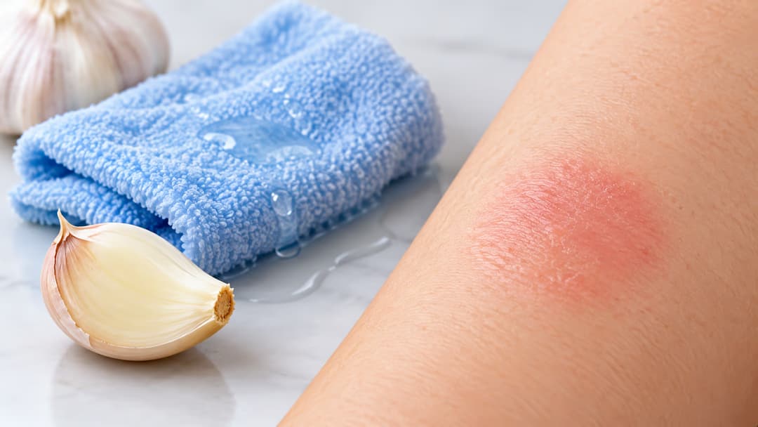 Bỏng da do đắp tỏi: Nguyên nhân và hướng dẫn xử lý đúng cách