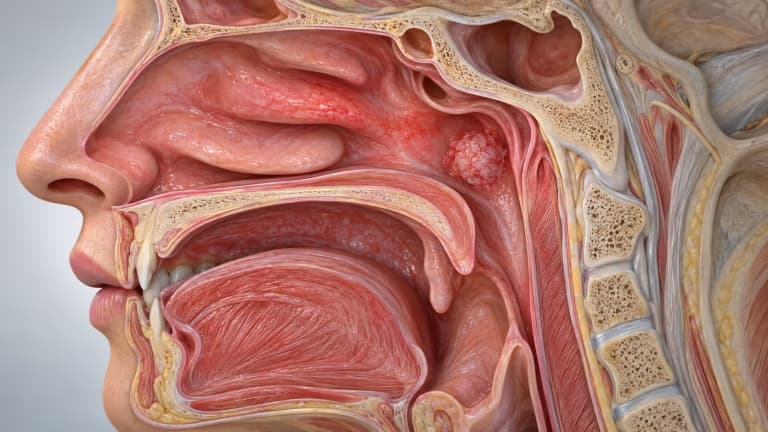 Phân biệt ung thư vòm họng và viêm vòm họng qua các đặc điểm thường gặp