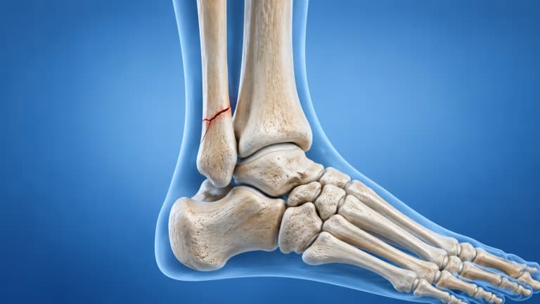 Gãy 1/3 dưới xương mác có nguy hiểm không