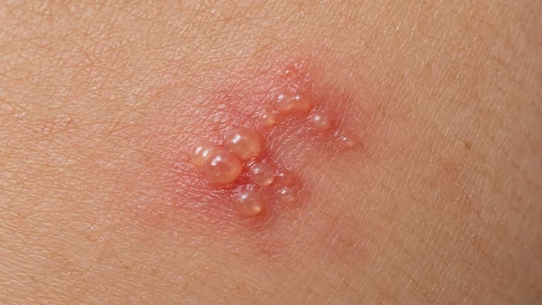 Mụn rộp sinh dục giai đoạn đầu có điều trị được không và những lưu ý cần biết