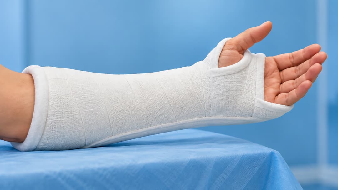 Nẹp bột có tác dụng gì trong điều trị chấn thương cơ xương khớp?