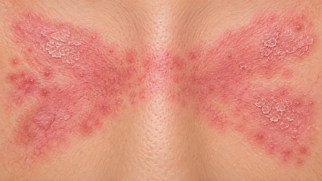 Biểu hiện bệnh lupus ban đỏ trên da và các dạng tổn thương thường gặp