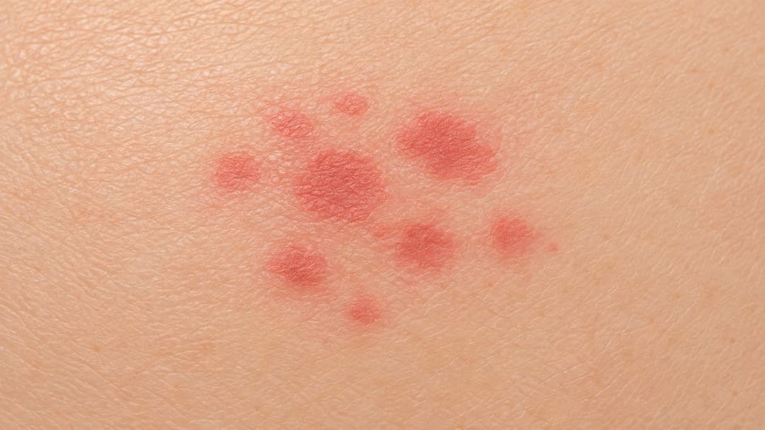 Nổi mẩn đỏ ở mông nhưng không ngứa là bị bệnh gì