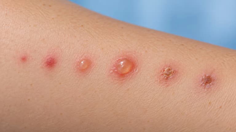 Hình ảnh mụn nước thủy đậu ở người lớn và các giai đoạn tiến triển
