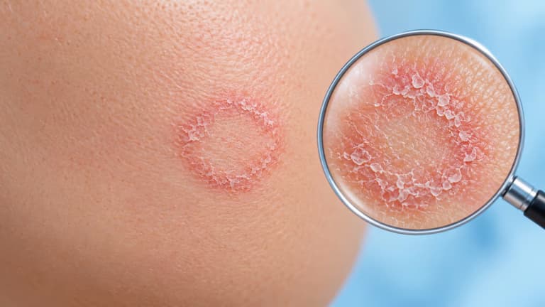 Hình thái tổn thương và biểu hiện thường gặp của nấm da mặt