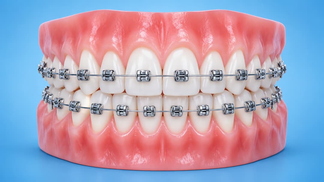 Niềng răng có hết móm không và ưu điểm khi điều trị chỉnh nha