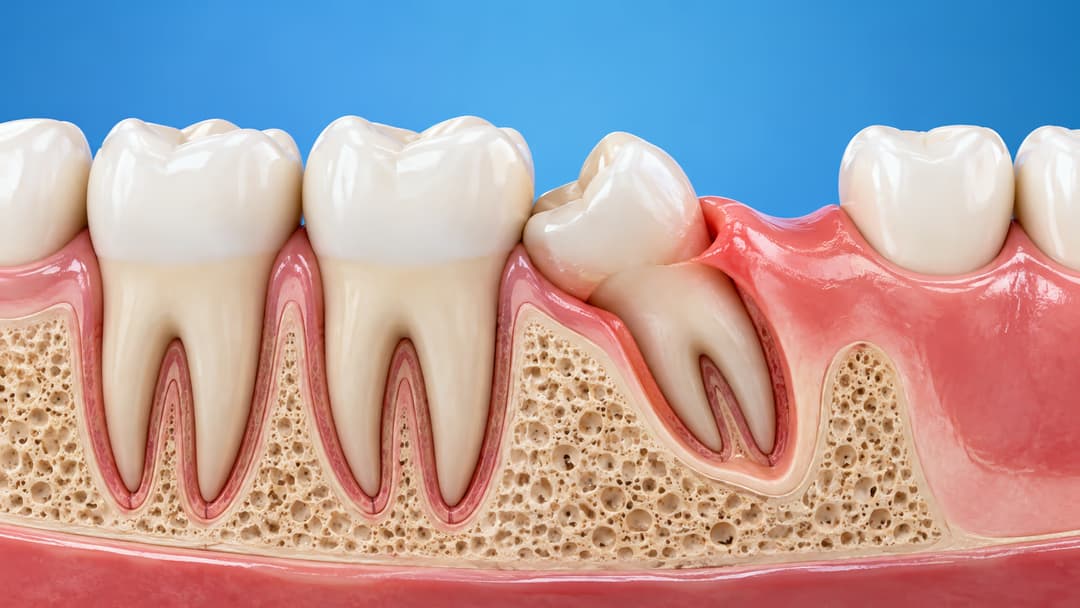 Răng mọc trên lợi: Nguyên nhân, ảnh hưởng và cách xử lý