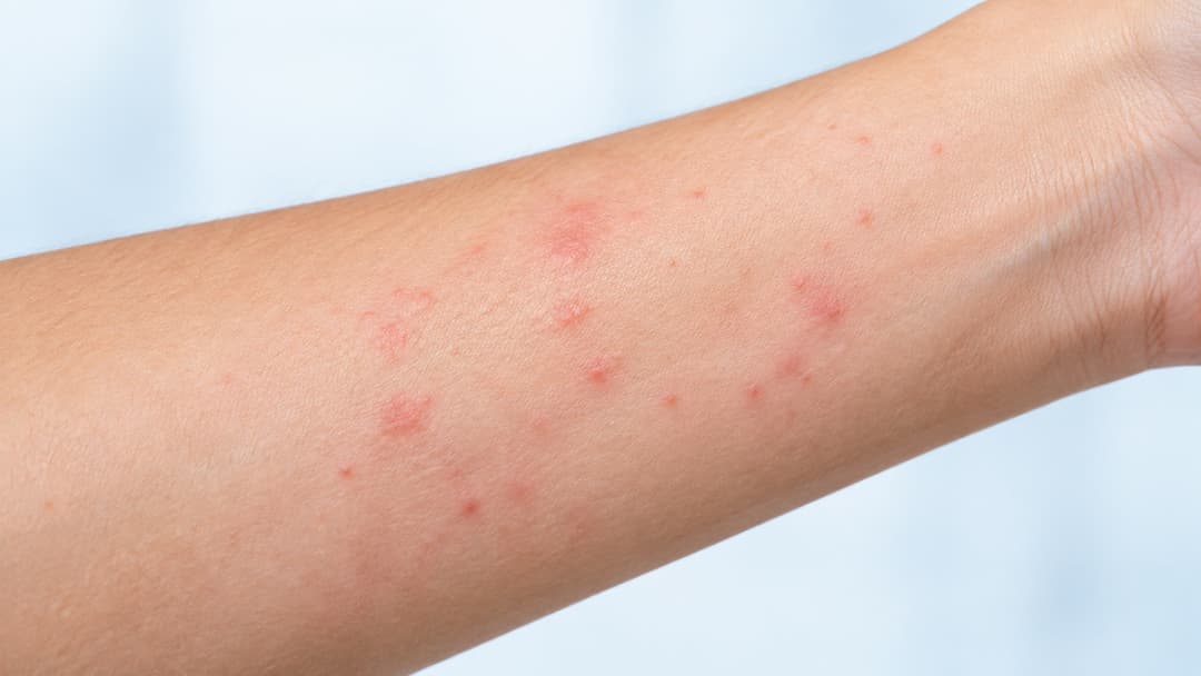 Sốt xuất huyết có ngứa không và cách khắc phục