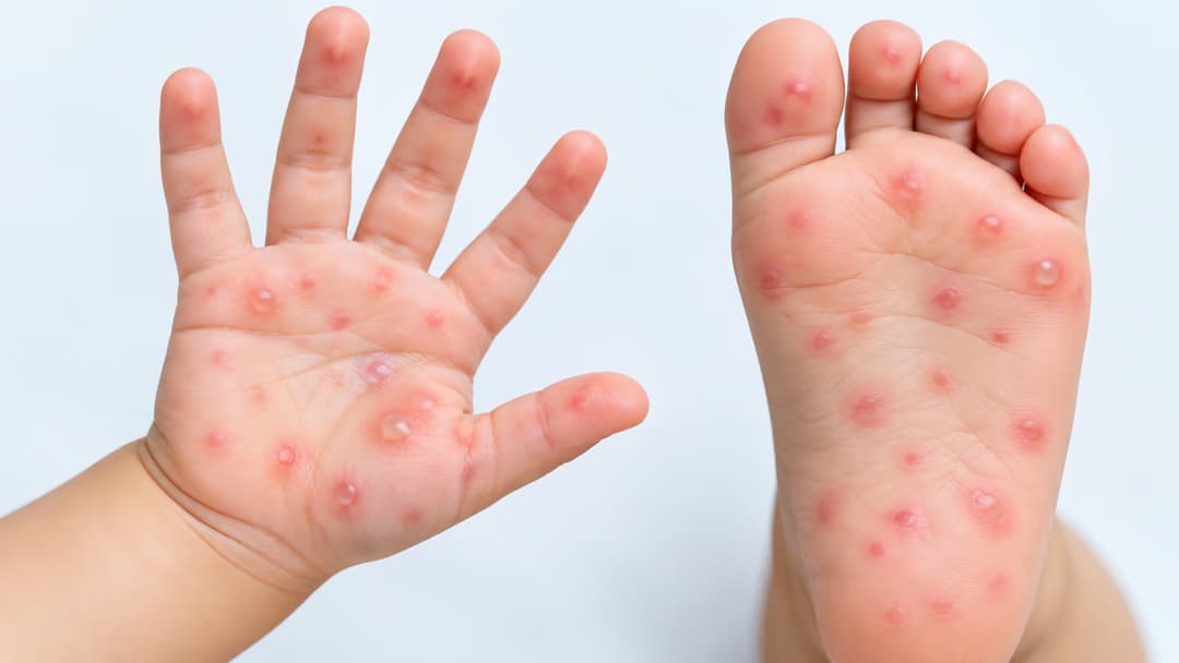 Nhận biết sớm bệnh tay chân miệng thể nặng và cách xử lý