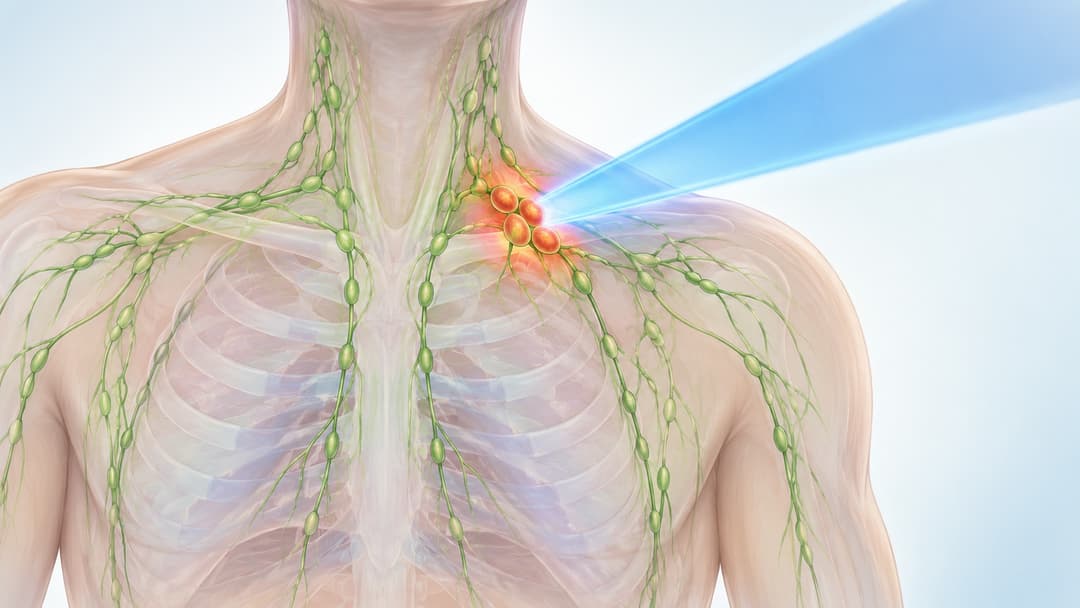 Xạ trị trong điều trị bệnh u lympho không Hodgkin
