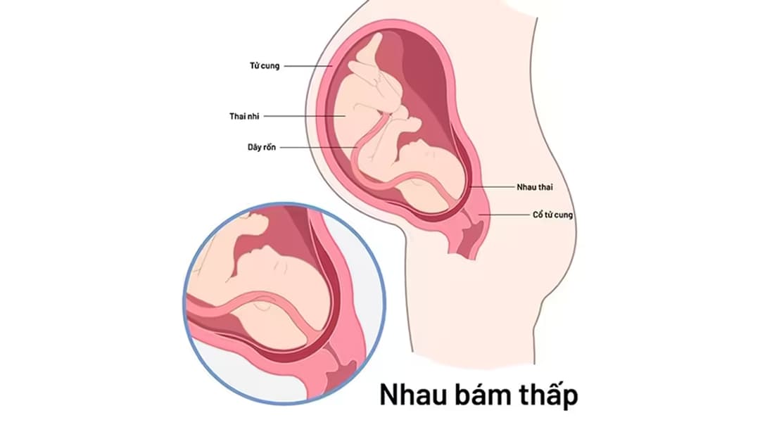 Nhau bám thấp trong thai kỳ