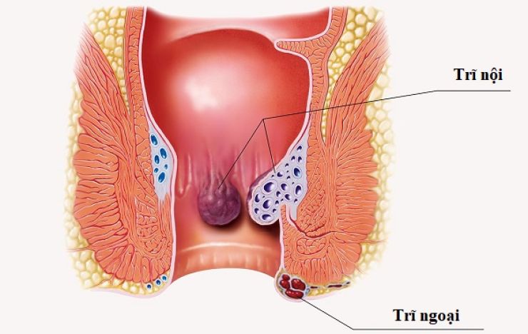 Bệnh trĩ có tự khỏi không, cần làm gì khi mắc trĩ?