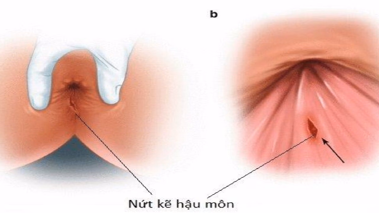Nứt kẽ hậu môn: Nguyên nhân, dấu hiệu và hỗ trợ cải thiện