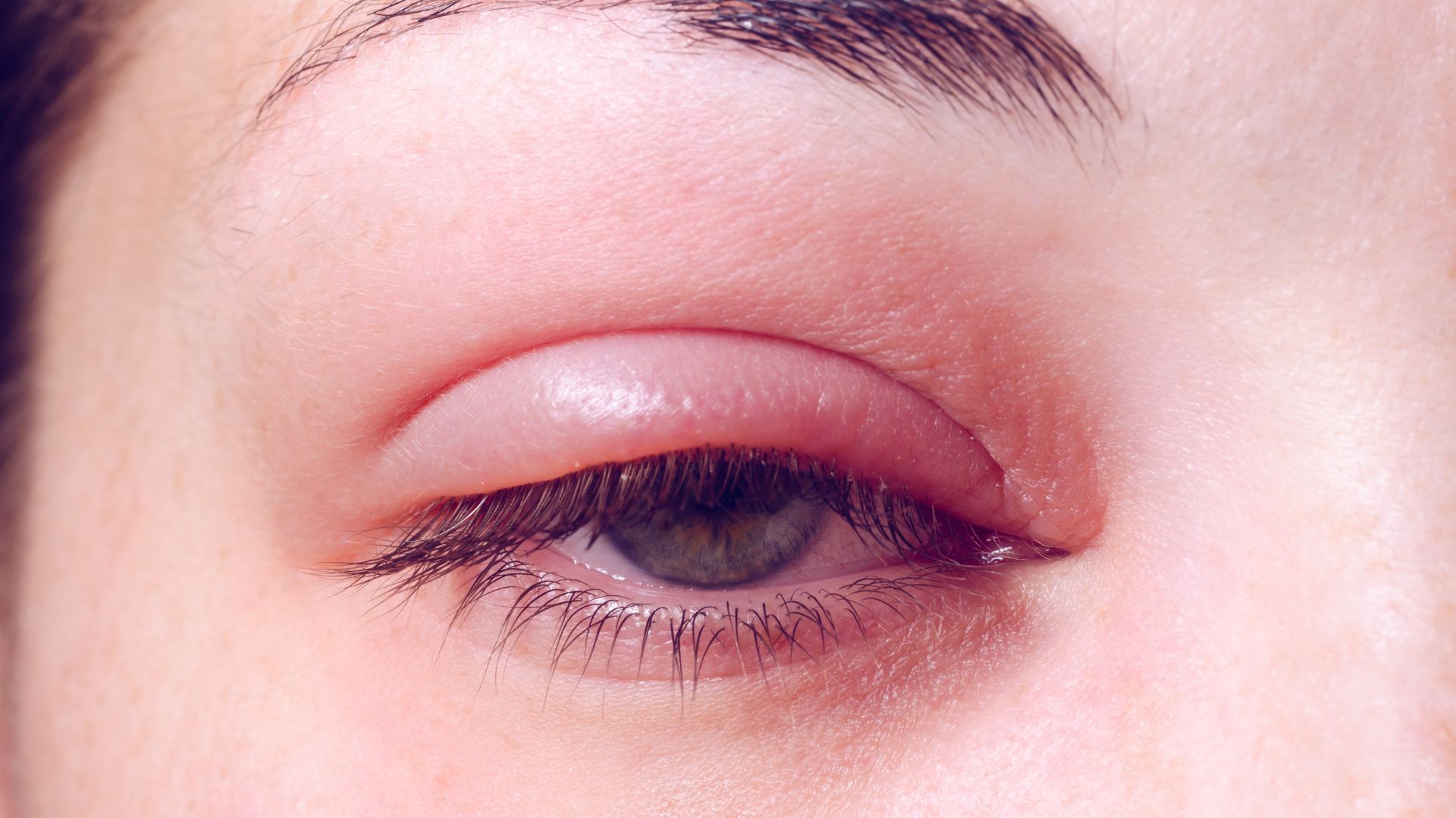 Viêm bờ mi bao lâu thì khỏi? Hiểu đúng để chăm sóc và phục hồi hiệu quả - Trung tâm Tiêm chủng Long Châu