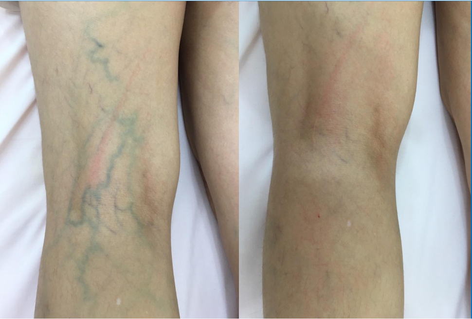 Vì sao nhân viên y tế dễ bị suy giãn tĩnh mạch chân?