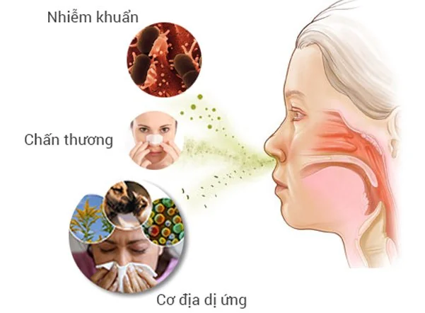 Minh họa các nguyên nhân gây viêm mũi dị ứng bao gồm nhiễm khuẩn, chấn thương và cơ địa dị ứng