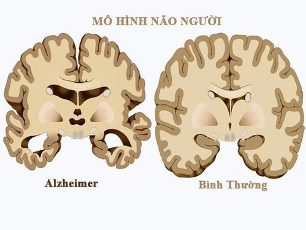 So sánh mô hình não bộ bình thường và não bộ mắc bệnh Alzheimer